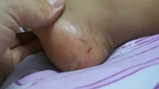 إنقاذ طفل من لدغة أفعى سامة بإقليم زاكورة يعيد النقاش حول الخصاص الصحي بالمناطق الجبلية
