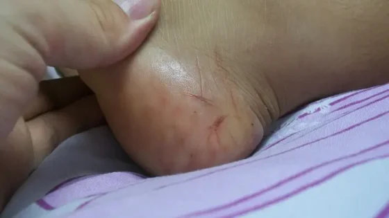 إنقاذ طفل من لدغة أفعى سامة بإقليم زاكورة يعيد النقاش حول الخصاص الصحي بالمناطق الجبلية